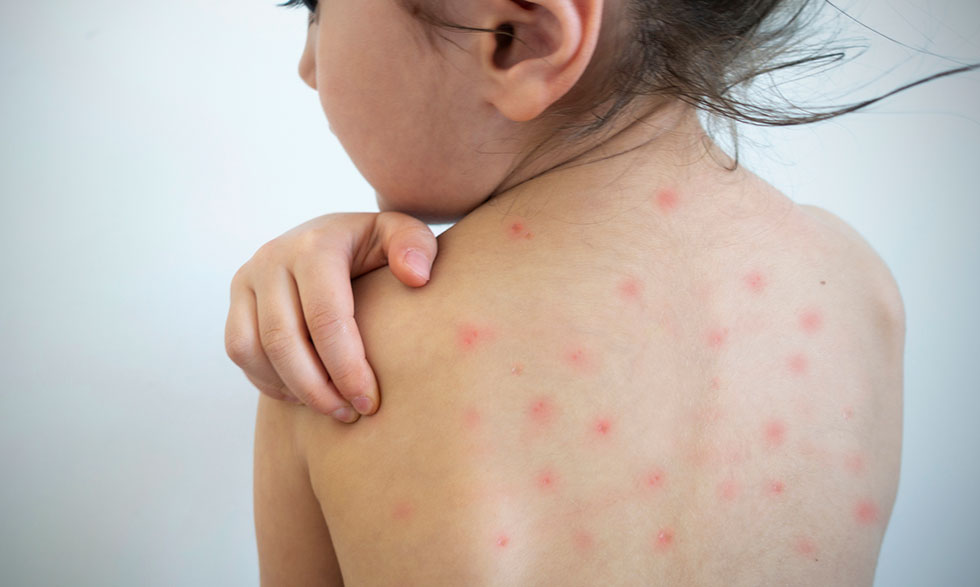 CCSS en Alerta: Sarampión en el País