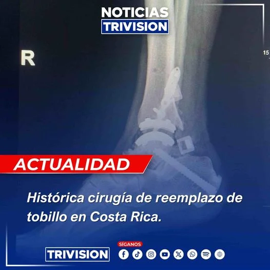 Reemplazo total de tobillo Costa Rica